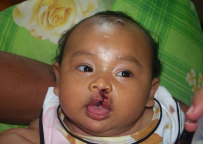 Children’s Corrective Surgery, Case 4