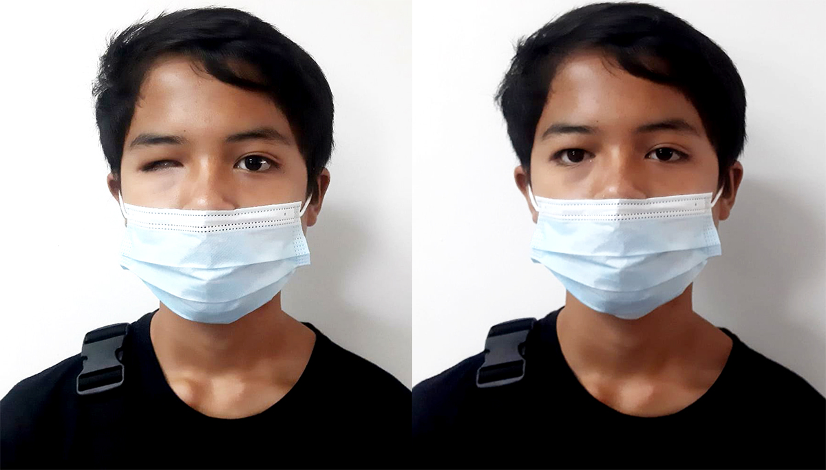 SIX PROSTHETIC EYES The John Fawcett Foundation