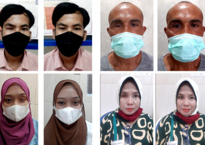 Prosthetic Eyes Project 4