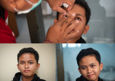 PROSTHETIC EYES